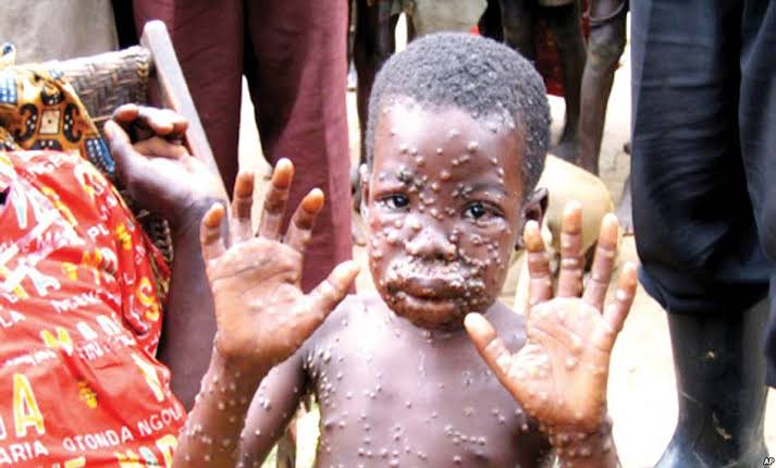 Monkey pox: Nasarawa confirms six cases in two LGAs